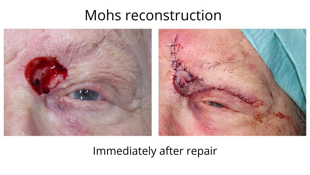 Mohs reconstruction before and after. The flap and stitched can be seen immediately after surgery. 