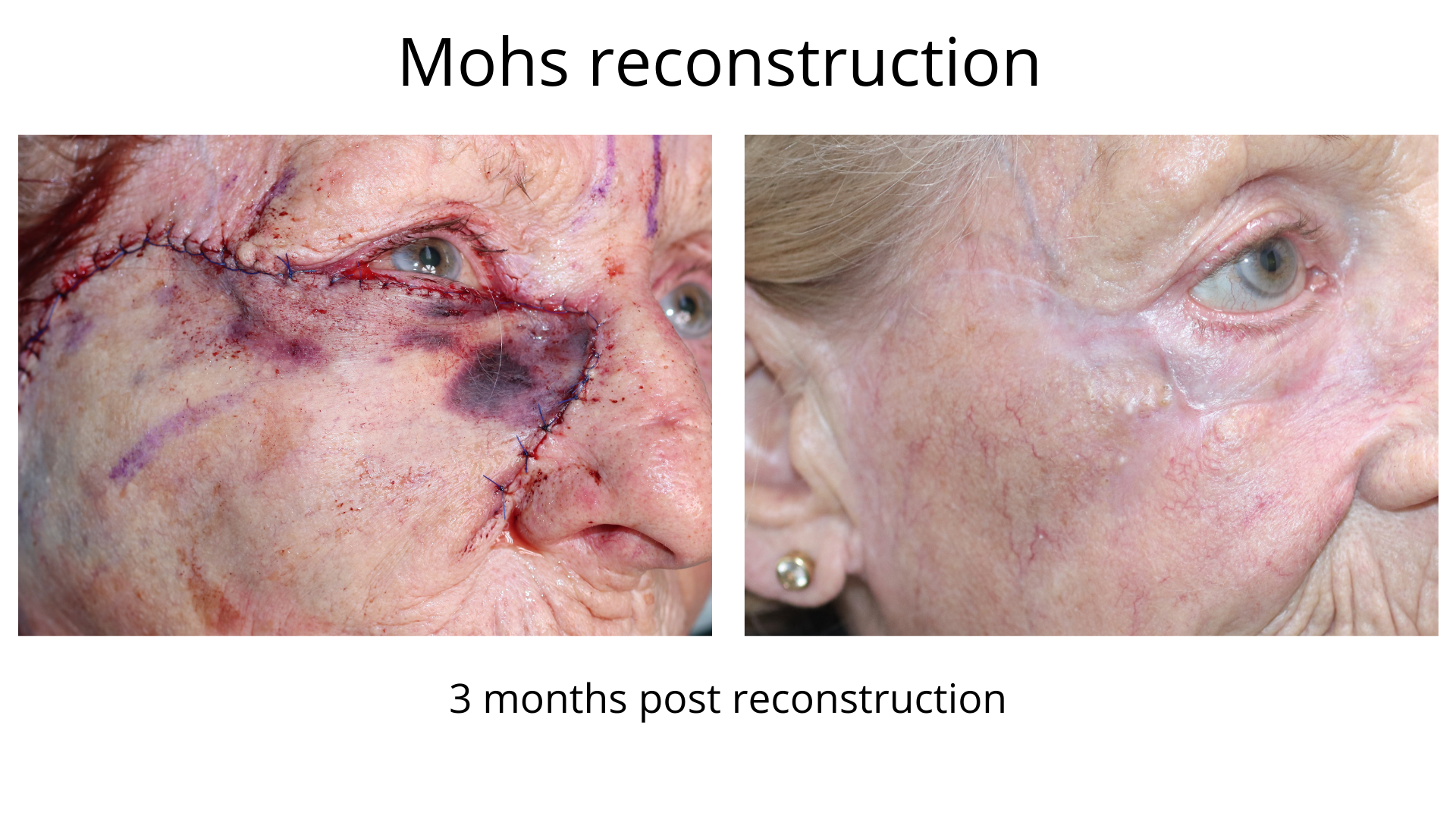 Before and after Mohs reconstruction surgery performed by Dr Anthony Maloof in Sydney.