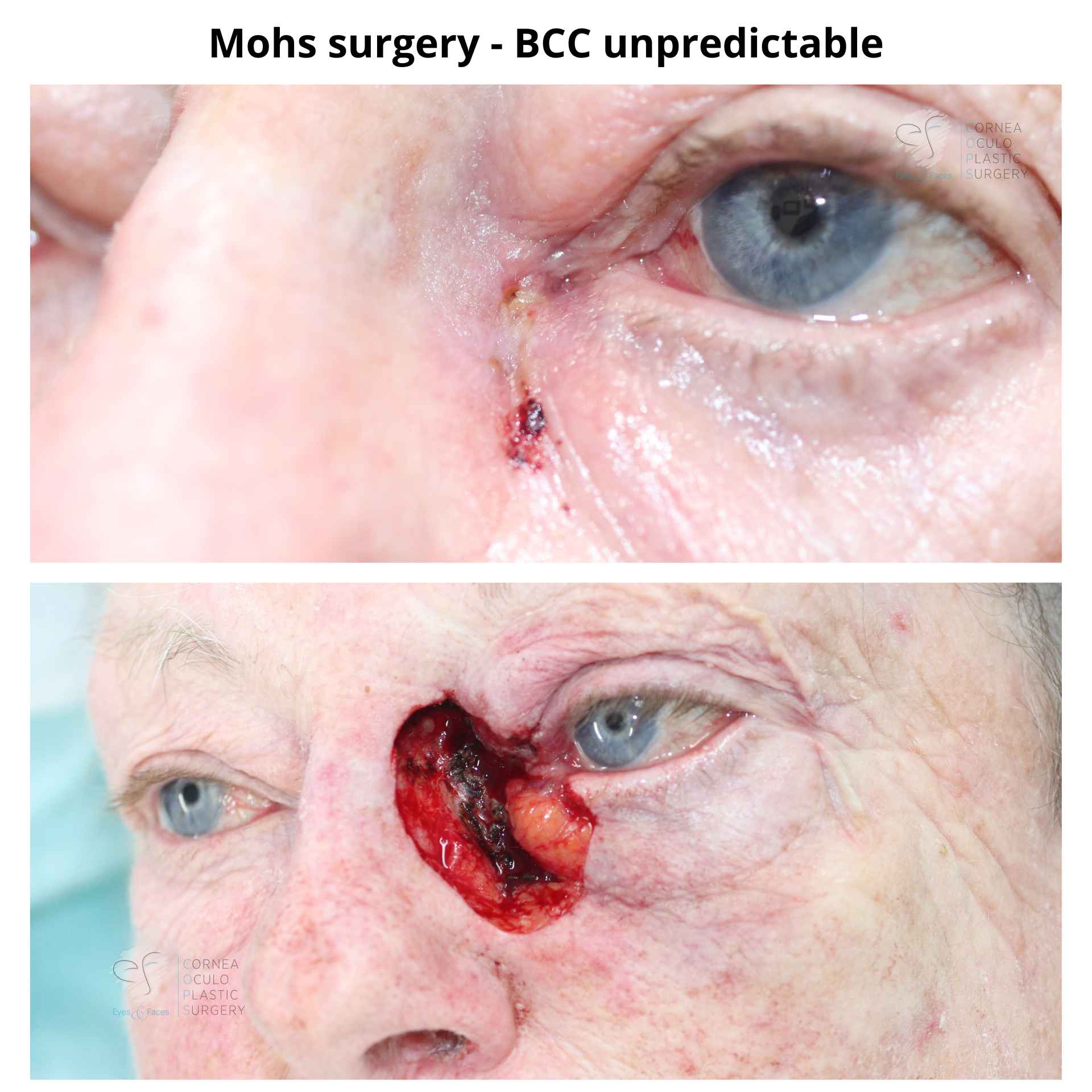 Mohs surgery. Skin cancer before surgery and defect left behind after removing the skin cancer via Mohs surgery.
