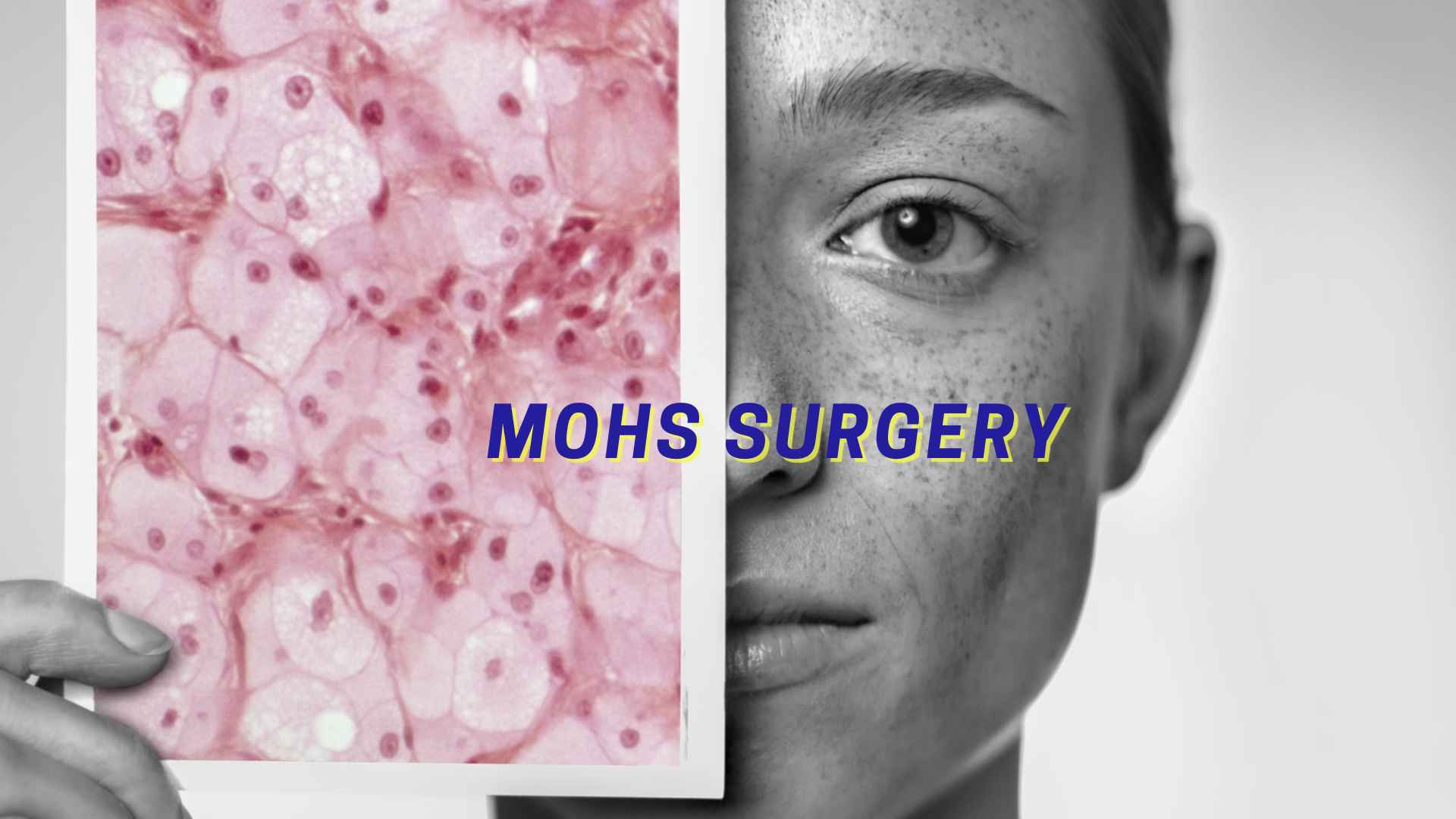Mohs Surgery - showing skin cancer cells