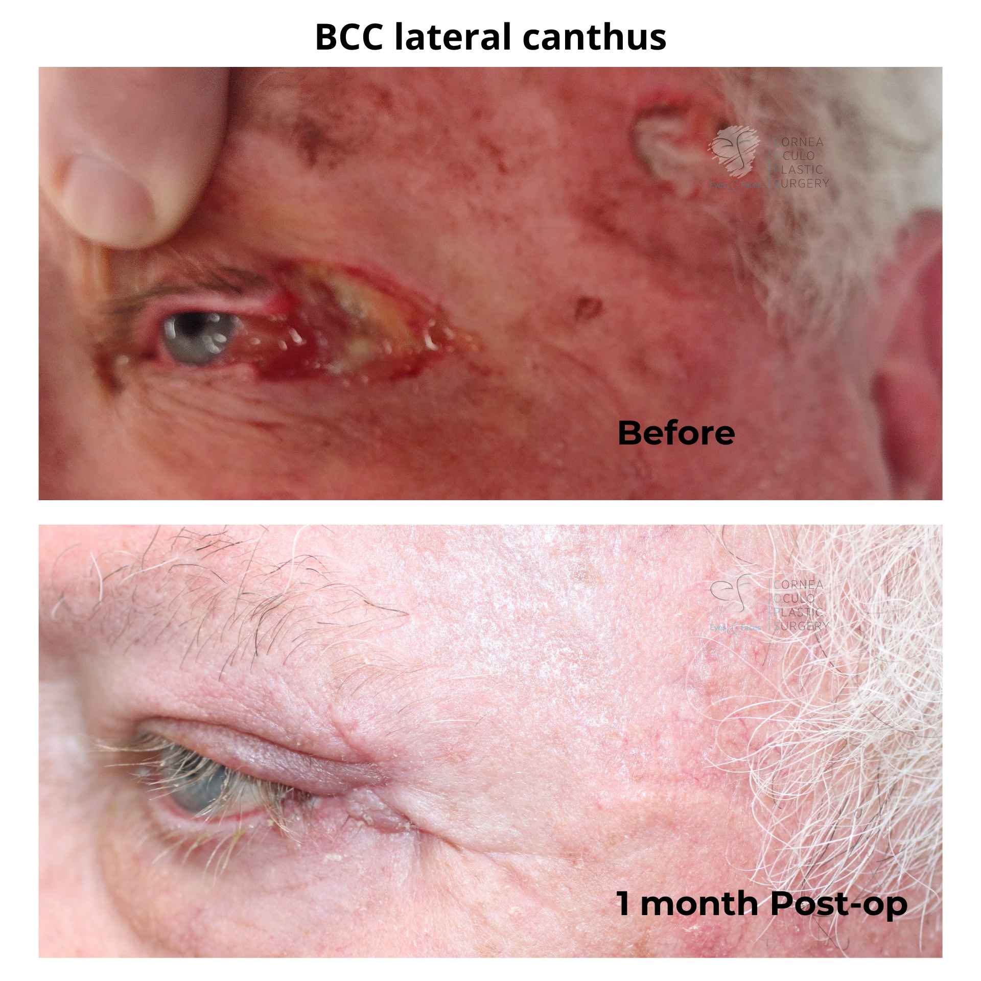 Nasty cancer of the eye. Second image shows 1 month after Dr Anthony Maloof performed a Mohs reconstruction.