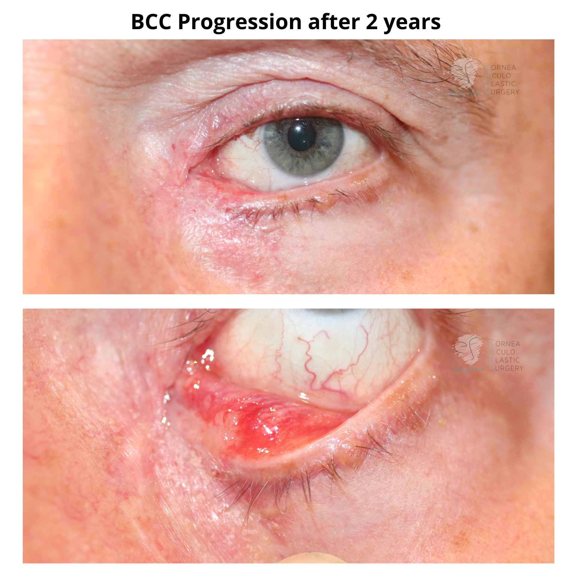 BCC progression after 2 years and no intervention. With the eyelid everted, you can see the BCC or cancer under the eyelid.
