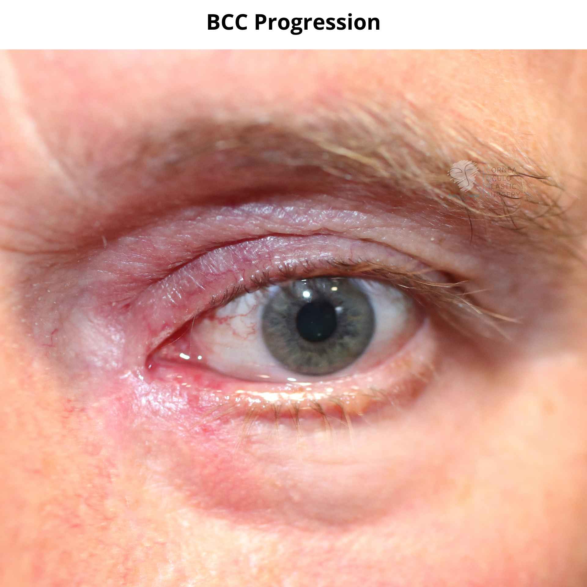 Patients BCC progression - this is a before photo from 2 years ago.