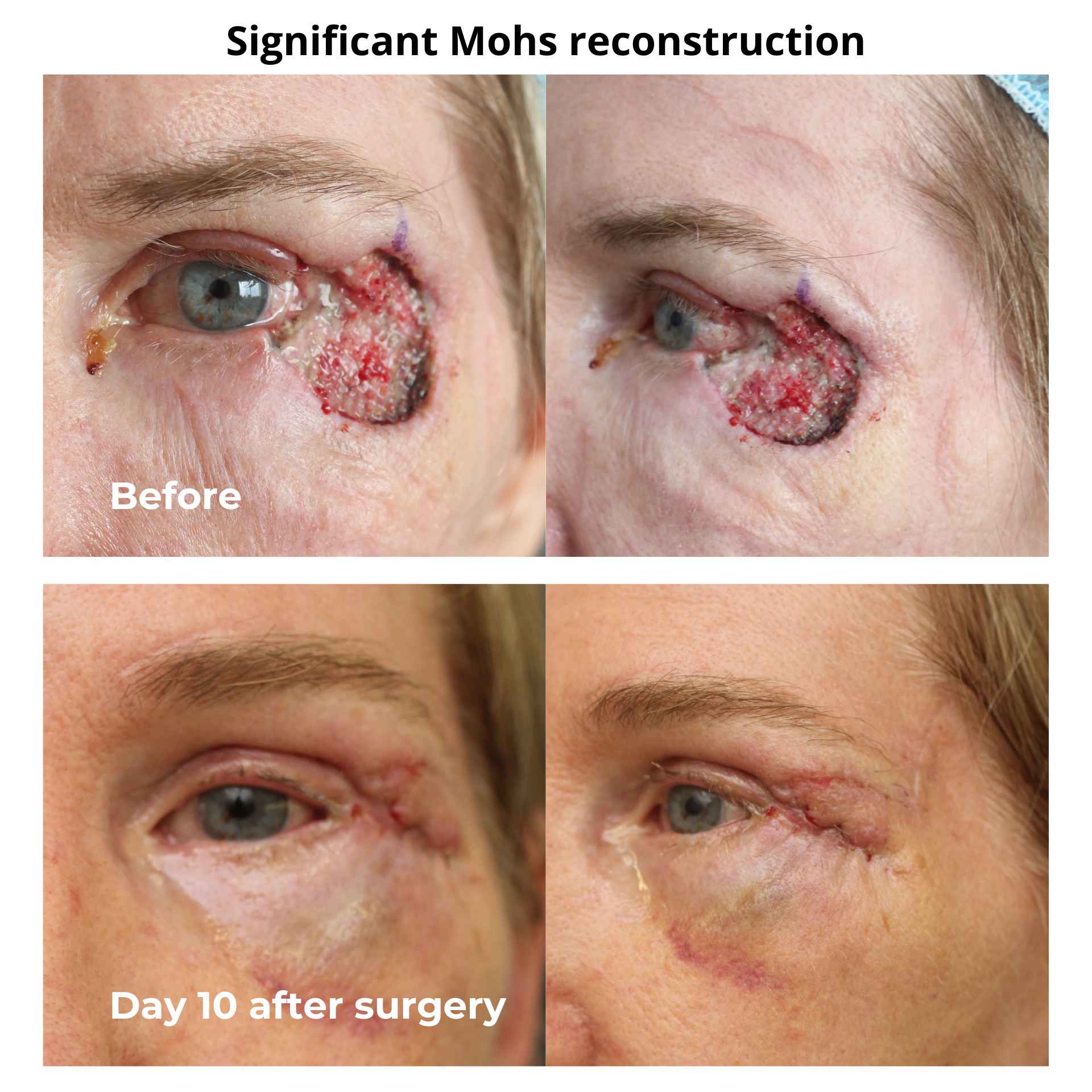 Invasive cancer involving the upper and lower lid. This is just 10 days post Mohs reconstruction surgery by Dr Anthony Maloof.