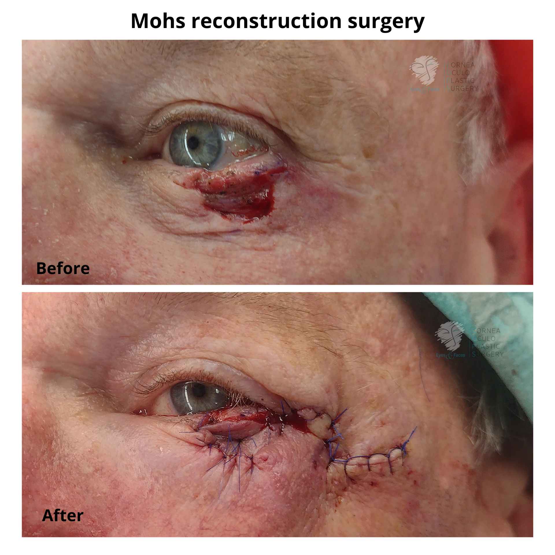 Mohs reconstruction surgery