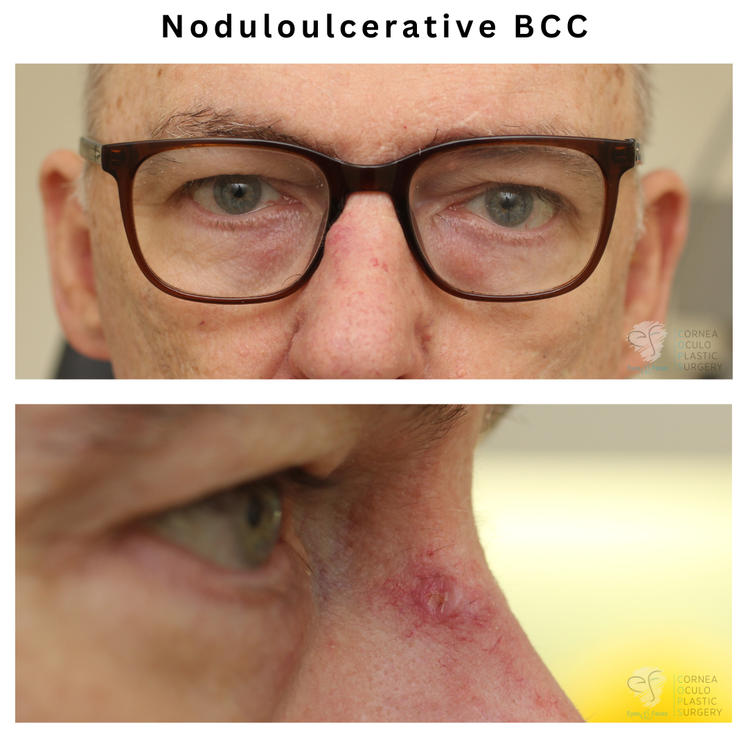 BCC or cancer hidden by glasses.