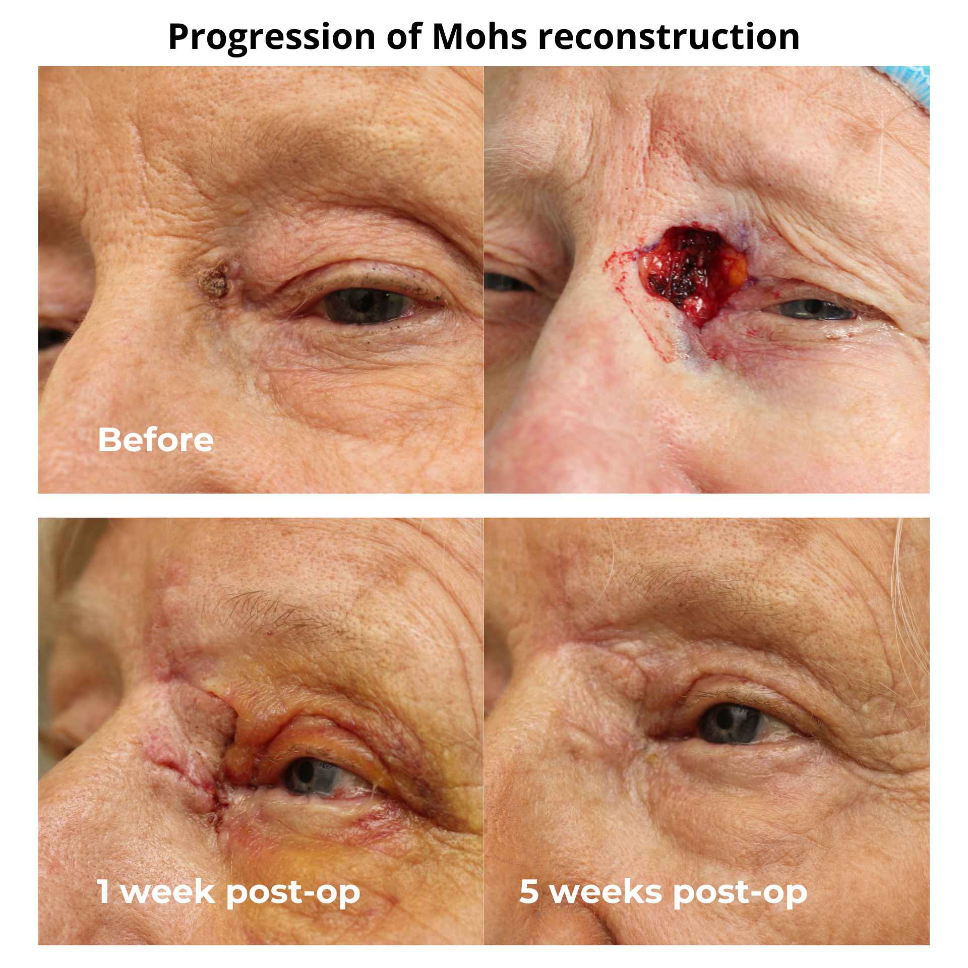 Progression of Mohs reconstruction showing the before and after phases.